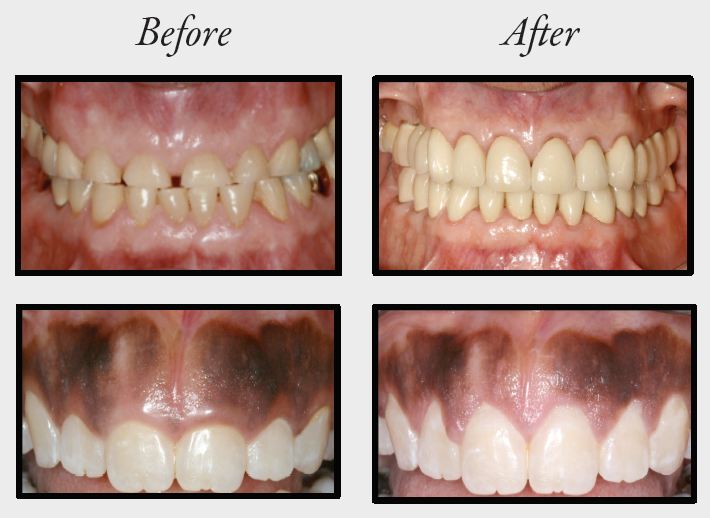 Crown Lengthening